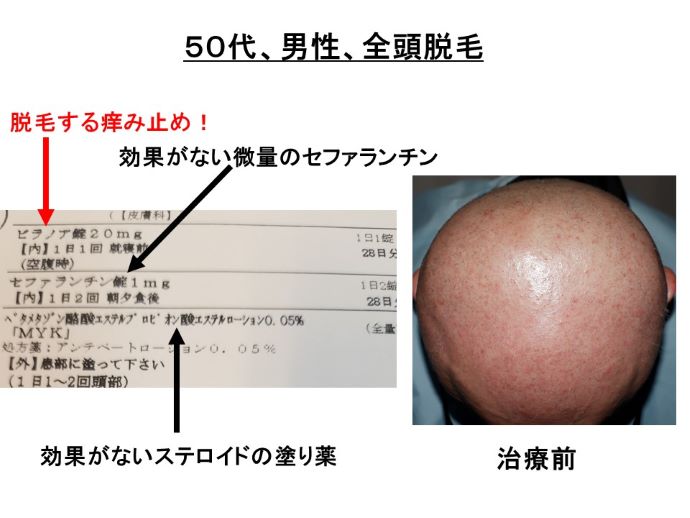 円形脱毛症　病院